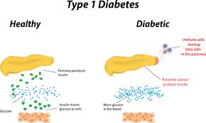 diabetes-1