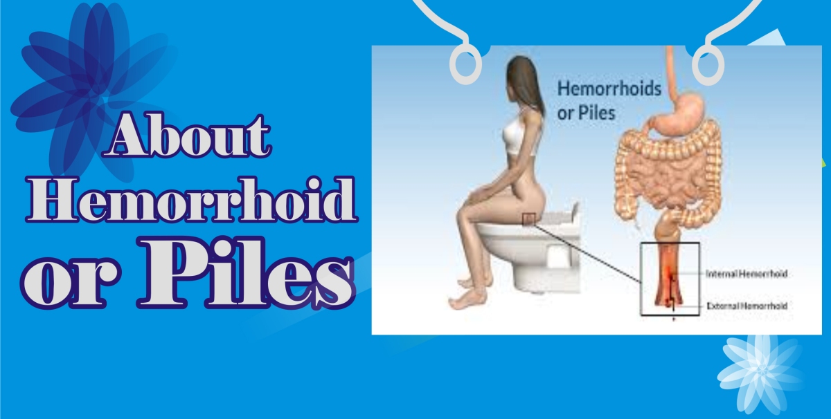 The Signs and Symptoms of Hemorrhoids